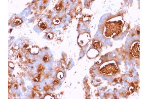 Formalin-fixed, paraffin-embedded human Colon Carcinoma stained with CEA Mouse Monoclonal Antibody (CEA31). (CEACAM5 抗体)
