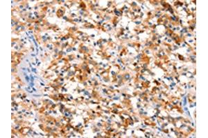 The image on the left is immunohistochemistry of paraffin-embedded Human thyroid cancer tissue using ABIN7192636(SPRN Antibody) at dilution 1/15, on the right is treated with synthetic peptide. (SPRN 抗体)