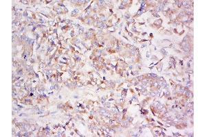 Formalin-fixed and paraffin embedded human lung carcinoma labeled with Anti-LDLRAD3 Polyclonal Antibody, Unconjugated  at 1:500 followed by conjugation to the secondary antibody and DAB staining (LDLRAD3 抗体  (AA 101-200))