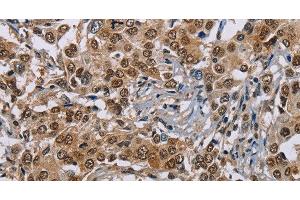 Immunohistochemistry of paraffin-embedded Human liver cancer using GTF2I Polyclonal Antibody at dilution of 1:40 (GTF2I 抗体)