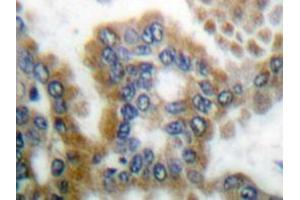 Immunohistochemistry analyzes of CrkL antibody in paraffin-embedded human lung carcinoma tissue. (CrkL 抗体)