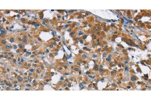 Immunohistochemistry of paraffin-embedded Human thyroid cancer tissue using ANKHD1 Polyclonal Antibody at dilution 1:40 (ANKHD1 抗体)