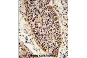 Formalin-fixed and raffin-embedded human lung carcinoma reacted with X Antibody (C-term), which was peroxidase-conjugated to the secondary antibody, followed by DAB staining. (XPA 抗体  (C-Term))