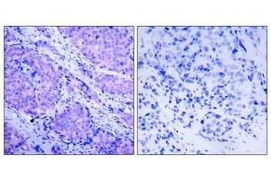 Immunohistochemical analysis of paraffin-embedded human breast carcinoma tissue using PDK1(Phospho-Ser241) Antibody(left) or the same antibody preincubated with blocking peptide(right). (PDPK1 抗体  (pSer241))