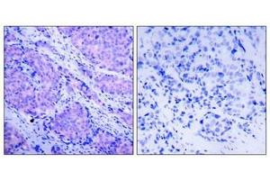 Immunohistochemical analysis of paraffin-embedded human breast carcinoma tissue using PDK1(Phospho-Ser241) Antibody(left) or the same antibody preincubated with blocking peptide(right).