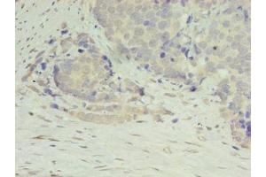 Immunohistochemistry of paraffin-embedded human gastric cancer using ABIN7150021 at dilution of 1:100 (DIP2A 抗体  (AA 1-300))