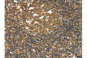 The image on the left is immunohistochemistry of paraffin-embedded Human tonsil tissue using ABIN7192667(STAB1 Antibody) at dilution 1/20, on the right is treated with synthetic peptide. (Stabilin 1 抗体)