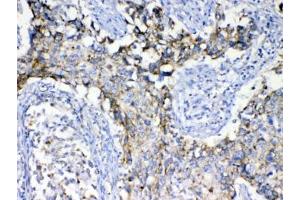 IHC testing of FFPE human lung cancer tissue with SCF antibody at 1ug/ml. (KIT Ligand 抗体)
