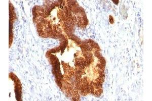 Formalin-fixed, paraffin-embedded human prostate carcinoma stained with Cytokeratin 18 antibody (KRT18/835). (Cytokeratin 18 抗体)