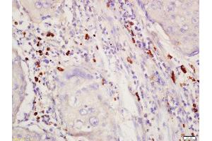 Formalin-fixed and paraffin embedded human lung cancer labeled with Rabbit Anti-SGK1 (Thr256) Polyclonal Antibody, Unconjugated 1:200 followed by conjugation to the secondary antibody and DAB staining (SGK1 抗体  (pThr256))