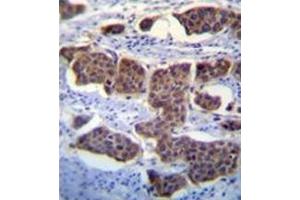 Iimmunohistochemistry analysis in formalin fixed and paraffin embedded human bladder carcinoma reacted with PALM3 Antibody (C-term) followed by peroxidase conjugation of the secondary antibody and DAB staining.
