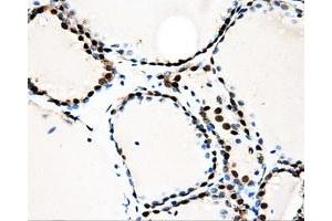Immunohistochemical staining of paraffin-embedded Adenocarcinoma of ovary tissue using anti-LOXmouse monoclonal antibody. (LOX 抗体  (AA 22-168))