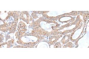 Immunohistochemistry of paraffin-embedded Human thyroid cancer tissue using PLGLB2 Polyclonal Antibody at dilution of 1:65(x200) (PLGLB2 抗体)