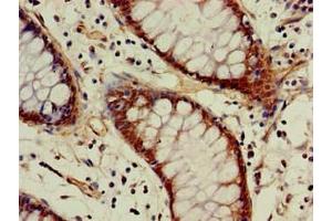 Immunohistochemistry of paraffin-embedded human colon cancer using ABIN7142946 at dilution of 1:100 (ACAT1 抗体  (AA 76-106))