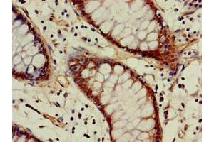 Immunohistochemistry of paraffin-embedded human colon cancer using ABIN7142946 at dilution of 1:100 (ACAT1 抗体  (AA 76-106))