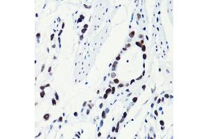 Immunohistochemistry of paraffin-embedded human gastric cancer using Acetyl-Histone H2B-K5 antibody (ABIN7267733) at dilution of 1:100 (40x lens). (Histone H2B 抗体  (acLys5))