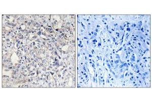 Immunohistochemistry analysis of paraffin-embedded human liver carcinoma tissue, using Heparin Cofactor II antibody. (SERPIND1 抗体  (N-Term))