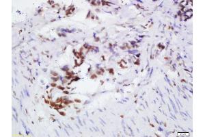 Formalin-fixed and paraffin embedded human colon cancer labeled with Rabbit Anti-OGG1 Polyclonal Antibody, Unconjugated 1:200 followed by conjugation to the secondary antibody and DAB staining, (OGG1 抗体  (AA 151-250))