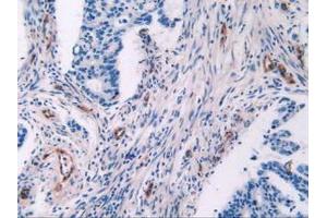 IHC-P analysis of Human Rectum Cancer Tissue, with DAB staining. (Endoglin 抗体  (AA 26-136))