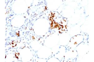 Formalin-fixed, paraffin-embedded human Angiosarcoma stained with Glycophorin A Mouse Monoclonal Antibody (GYPA/280). (CD235a/GYPA 抗体)