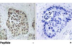 Immunohistochemical analysis of paraffin-embedded human lung carcinoma tissue using DCLRE1C polyclonal antibody . (DCLRE1C 抗体)
