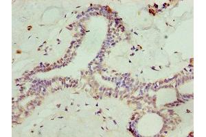 Immunohistochemistry of paraffin-embedded human breast cancer using ABIN7168634 at dilution of 1:100 (Sclerostin 抗体  (AA 24-213))