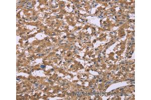 Immunohistochemistry of Human thyroid cancer using IFNA2 Polyclonal Antibody at dilution of 1:40 (IFNA2 抗体)