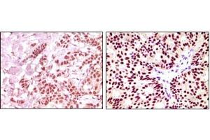 Immunohistochemical analysis of paraffin-embedded human breast carcinoma, using ER-alpha mouse mAb showing nuclear expression with DAB staining. (Estrogen Receptor alpha 抗体)