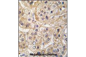Formalin-fixed and paraffin-embedded human hepatocarcinoma tissue reacted with EGFR Antibody (S1070), which was peroxidase-conjugated to the secondary antibody, followed by DAB staining. (EGF 抗体  (AA 1048-1077))