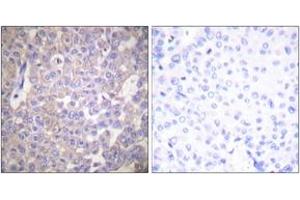 Immunohistochemistry analysis of paraffin-embedded human breast carcinoma tissue, using Claudin 2 Antibody. (Claudin 2 抗体  (AA 181-230))