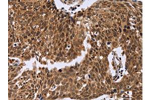 The image on the left is immunohistochemistry of paraffin-embedded Human cervical cancer tissue using ABIN7129394(ERCC6L Antibody) at dilution 1/30, on the right is treated with fusion protein. (ERCC6L 抗体)