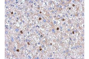 IHC-P Image Immunohistochemical analysis of paraffin-embedded human hepatoma, using MYST2, antibody at 1:250 dilution.