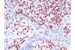 Formalin-fixed, paraffin-embedded human lung carcinoma stained with TTF1 antibody (8G7G3/1 + NX2. (TTF1 抗体)