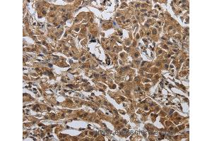 Immunohistochemistry of Human ovarian cancer using PDCD7 Polyclonal Antibody at dilution of 1:60 (PDCD7 抗体)
