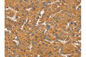 The image on the left is immunohistochemistry of paraffin-embedded Human liver cancer tissue using ABIN7131123(SNX11 Antibody) at dilution 1/30, on the right is treated with fusion protein. (SNX11 抗体)