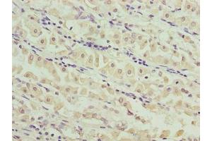 Immunohistochemistry of paraffin-embedded human gastric cancer using ABIN7159191 at dilution of 1:100 (MND1 抗体  (AA 2-205))