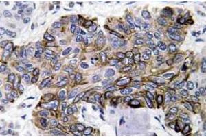 Immunohistochemistry analysis of RANTES Antibody in paraffin-embedded human lung carcinoma tissue. (CCL5 抗体)