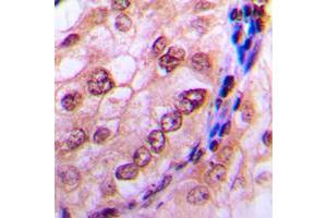 Immunohistochemical analysis of CDC6 (pS54) staining in human breast cancer formalin fixed paraffin embedded tissue section. (CDC6 抗体  (N-Term, pSer54))