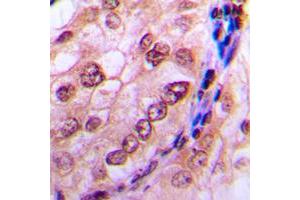 Immunohistochemical analysis of CDC6 (pS54) staining in human breast cancer formalin fixed paraffin embedded tissue section.