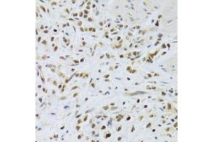 Immunohistochemistry of paraffin-embedded human gastric cancer using RAD50 Antibody. (RAD50 抗体)