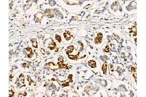 ABIN6258416 and ABIN6274632 at 1/100 staining Human pancreatic cancer and adjacent nomal tissues by IHC-P.