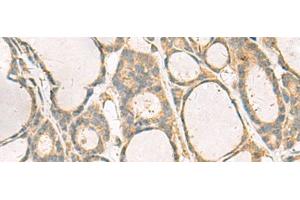Immunohistochemistry of paraffin-embedded Human thyroid cancer tissue using KIF2C Polyclonal Antibody at dilution of 1:70(x200) (KIF2C 抗体)