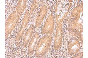 IHC-P Image IMPDH2 antibody detects IMPDH2 protein at cytosol on human colon carcinoma by immunohistochemical analysis. (IMPDH2 抗体)