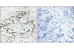 Immunohistochemistry analysis of paraffin-embedded human breast carcinoma tissue, using ERF Antibody. (ERF 抗体  (AA 471-520))