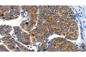 Immunohistochemistry of paraffin-embedded Human liver cancer using IGF2BP1 Polyclonal Antibody at dilution of 1:40 (IGF2BP1 抗体)
