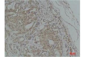 Immunohistochemistry (IHC) analysis of paraffin-embedded Human Breast Carcinoma using TGFbeta1 Polyclonal Antibody. (TGFB1 抗体)