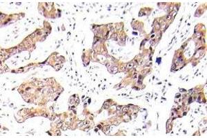 Immunohistochemistry (IHC) analyzes of p-FKHR/FOXO1A antibody in paraffin-embedded human breast carcinoma tissue. (FOXO1 抗体  (pSer256))