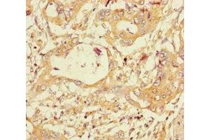 Immunohistochemistry of paraffin-embedded human pancreatic cancer using ABIN7160703 at dilution of 1:100 (PGLYRP2 抗体  (AA 22-576))