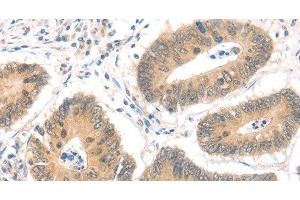 Immunohistochemistry of paraffin-embedded Human colon cancer using MAGED1 Polyclonal Antibody at dilution of 1:30 (MAGED1 抗体)