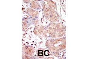 Formalin-fixed and paraffin-embedded human cancer tissue reacted with MAK polyclonal antibody  , which was peroxidase-conjugated to the secondary antibody, followed by DAB staining. (MAK 抗体  (C-Term))